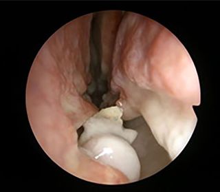 Doctors used an endoscope (a flexible tube with an attached light and camera) to take this photo before they extracted the tooth from the man's nose.