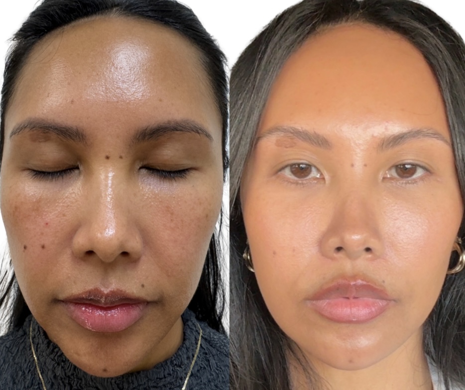 Vanessa Lee PicoSure Pro Laser Before and After Photos