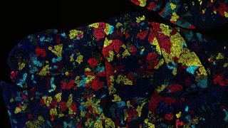 Mosaic-like image shows a variety of pancreatic cancer cell clusters depicted in red, yellow and light blue within a tumor.