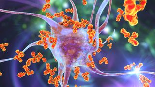 bright orange antibodies depicted attacking a purple neuron