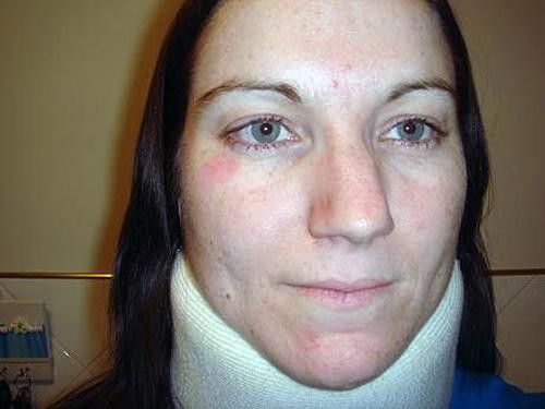The flesh wounds to Meares' face have