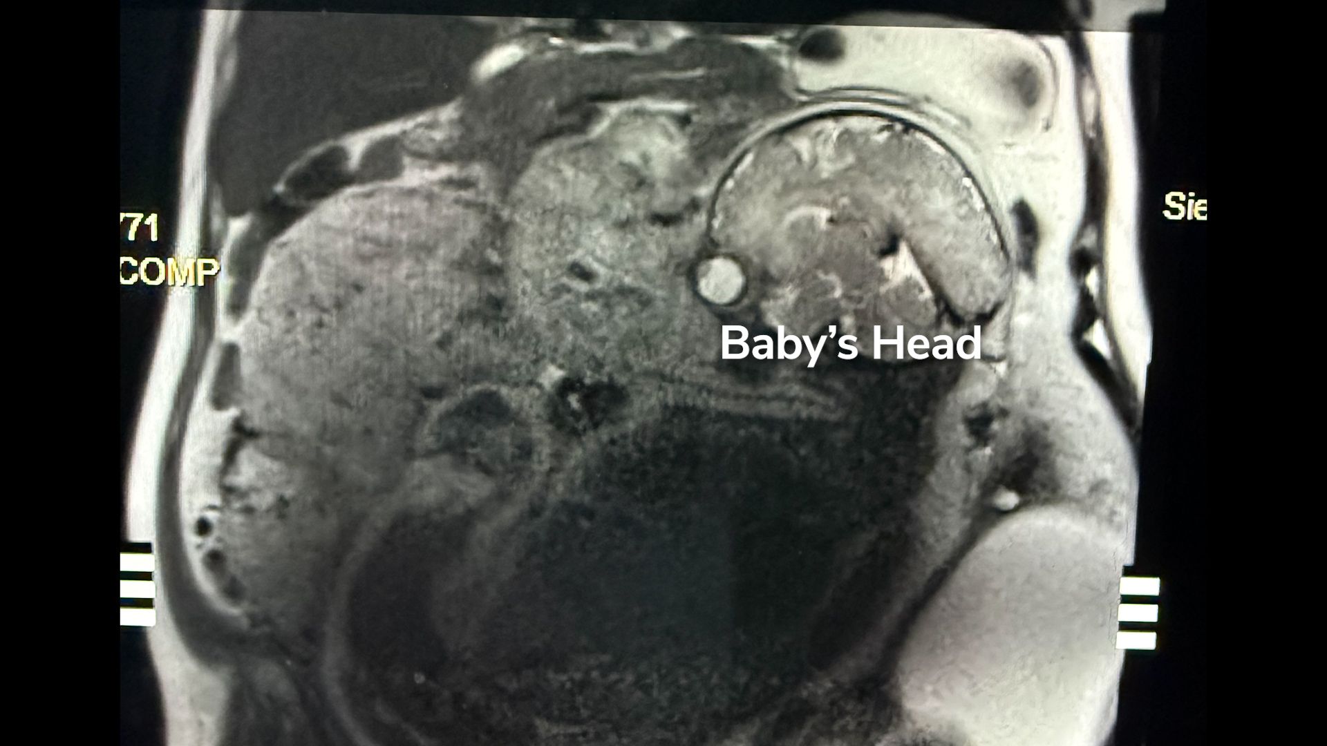 a medical scan with a portion of the upper right abdomen labeled "baby's head"