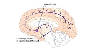 A diagram depicting the placement of deep brain stimulation electrodes Credit: University of Iowa