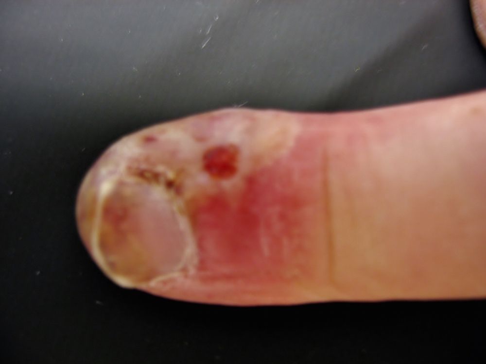 Herpes Virus Gives Man a Blistery Finger Infection