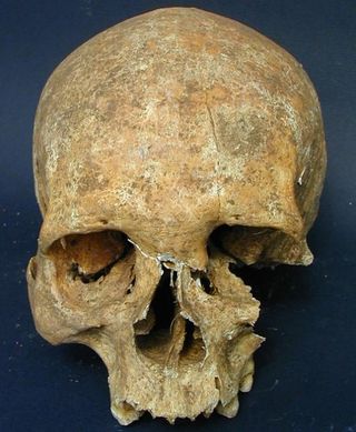 Bone wasting reveals the owner of this medieval skull to have suffered from leprosy. An unhealed gash on the forehead suggests that the leper warrior died a violent death, perhaps in battle.