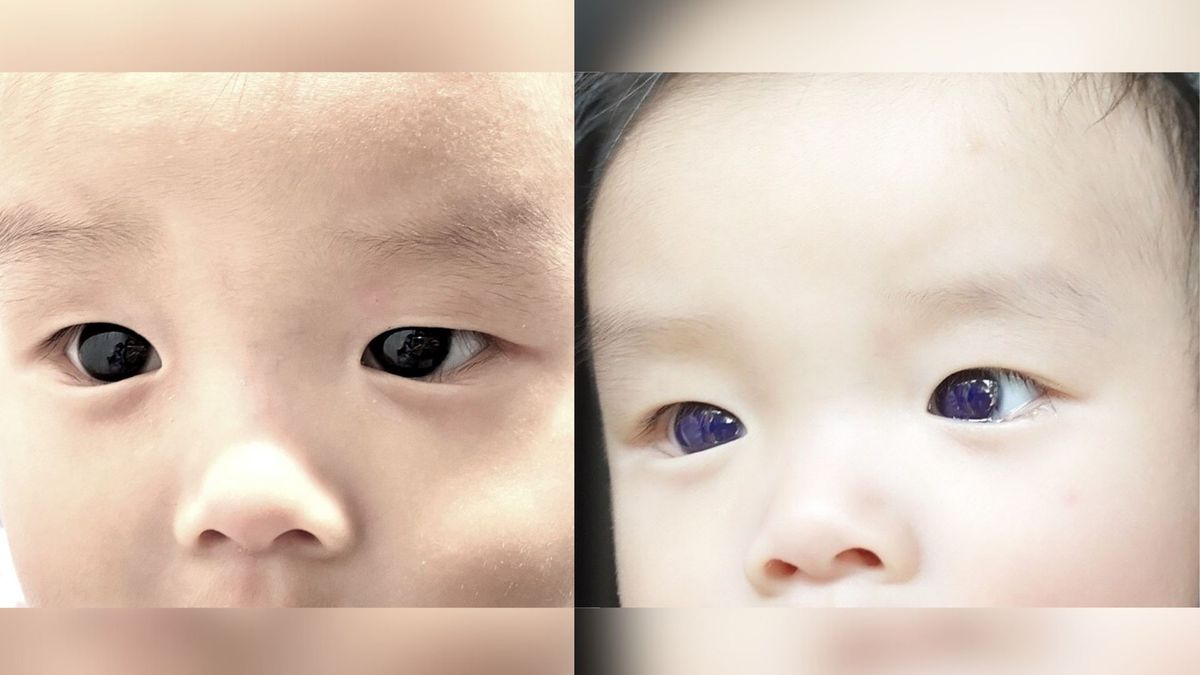 two photos show a close up of an infant&#039;s dark brown eyes (left) and then show how his eyes turned blue (right) after he was given a specific antiviral drug