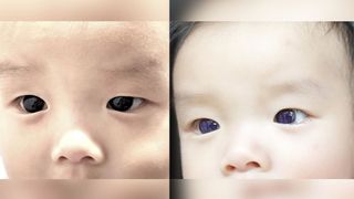two photos show a close up of an infant's dark brown eyes (left) and then show how his eyes turned blue (right) after he was given a specific antiviral drug