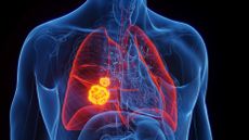 illustration shows an x-ray view into a human torso, showing a lung with a tumor in it