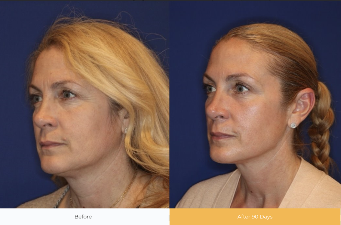 a before and after photo of a woman&#039;s face and neck