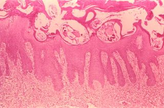 An image showing scabies mites that have burrowed into the upper layer of a patient&#039;s skin.