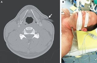 An image of a patient who had a tree branch penetrate his neck during a biking accident. 