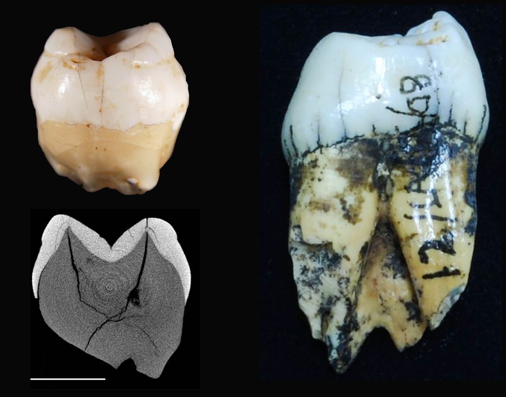 Photographs and a scan of the ancient human teeth found in the Lida Ajer cave by Eugene Dubois in the 1880s.