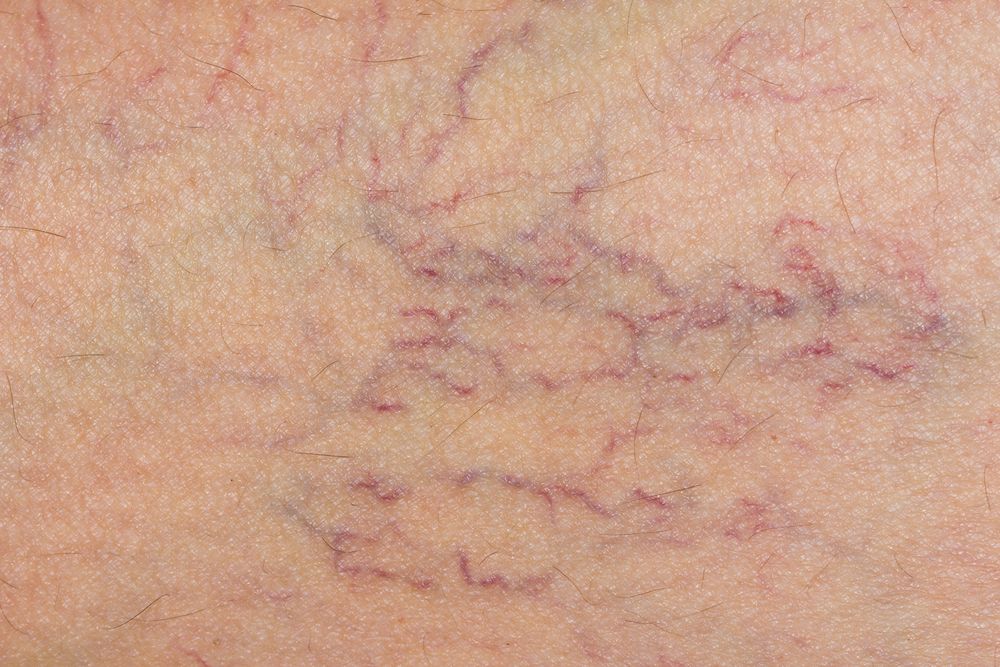 vericose veins, health