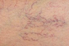 vericose veins, health