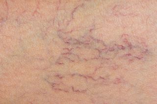 vericose veins, health