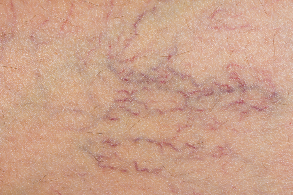 Spider veins, Symptoms & Causes