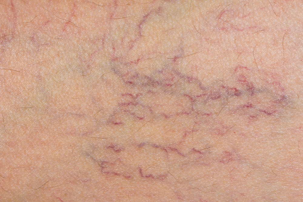 SPIDER VEINS