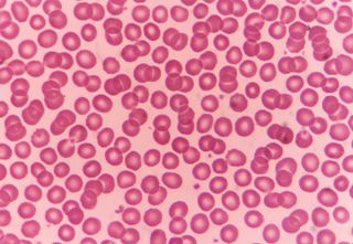Here is what normal, healthy red blood cells look like under a microscope.