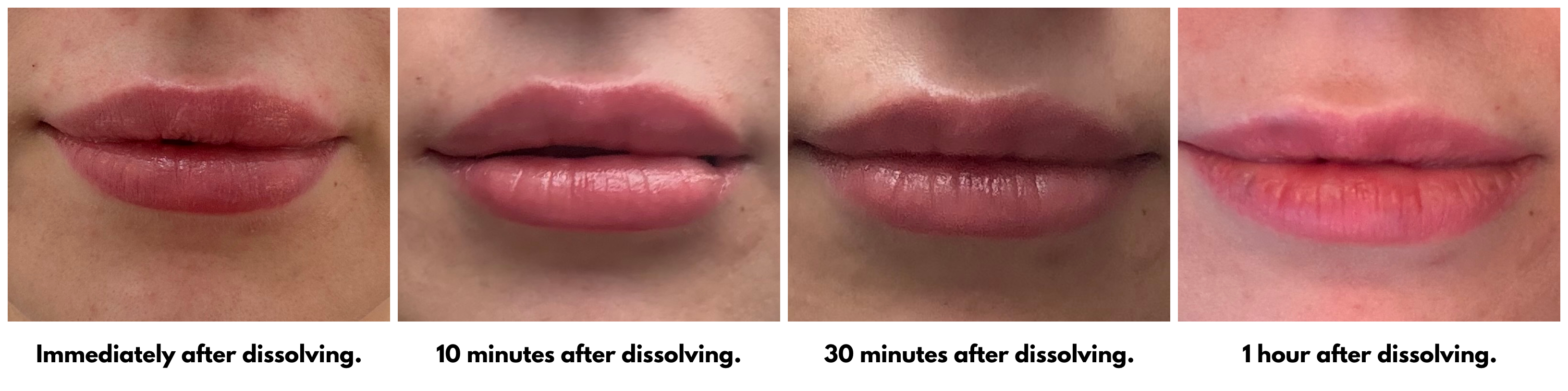 Siena Gagliano's lips after getting her filler dissolved at Ject. Left to Right: Immediately after dissolving; 10 minutes after dissolving; 30 minutes after dissolving; 1 hour after dissolving.