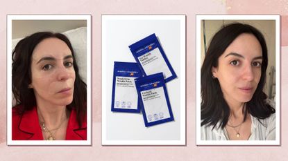 I tried Wrinkles Schminkles patches - they're just like Botox | Woman