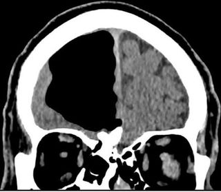 A CT scan of the patient's brain, showing a large, black space in part of the brain, which is actually an air pocket or pneumatocele.