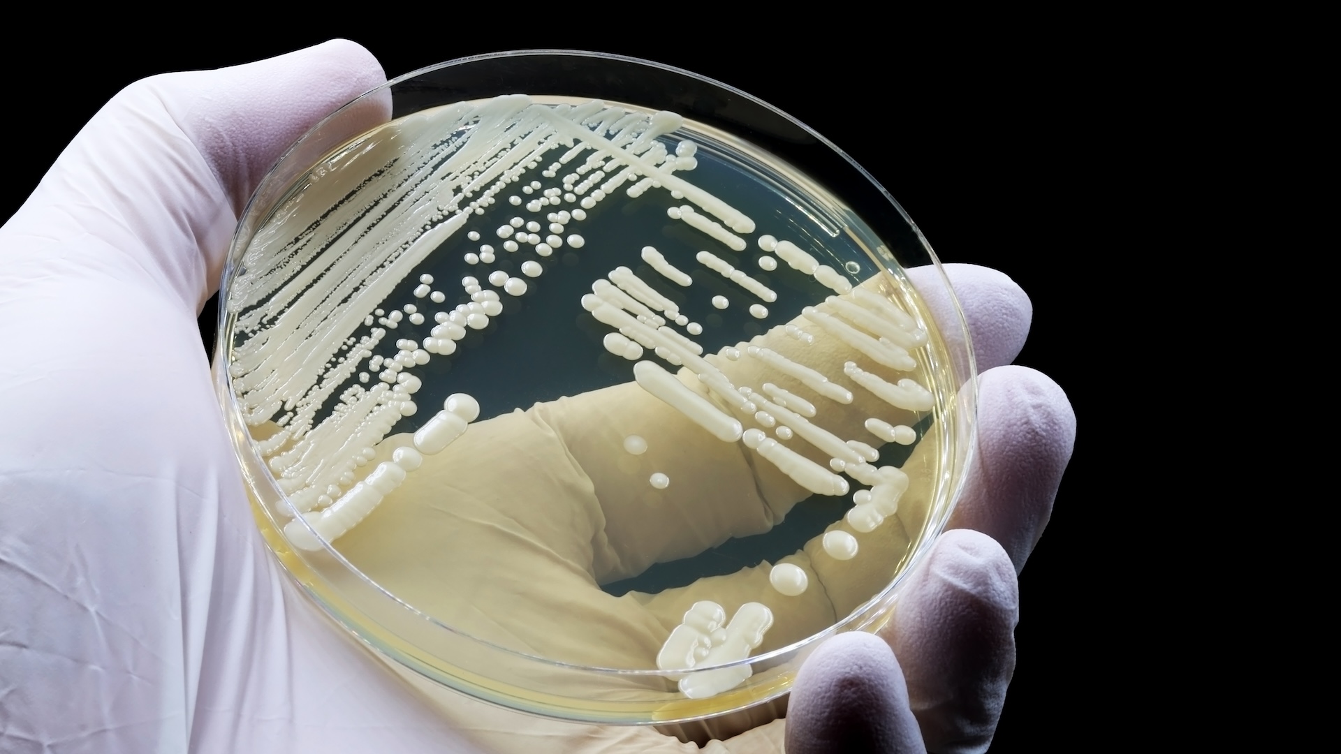  New fungal infection discovered in China 