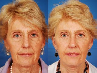 Here, a photo of participant Barbara Diehl before (left) and after (right) her lower eye and face lift. Post-surgery, Diehl showed a trend towards being perceived as more risk seeking, attractive and more sociable, though the trend was not statistically significant.