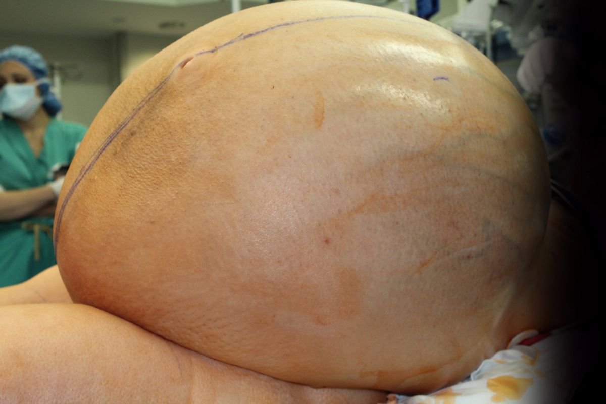 ovarian tumor