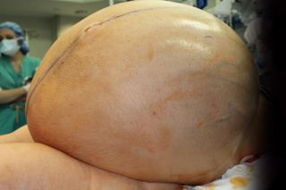 ovarian tumor