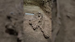 A skeleton found in Borneo that underwent a leg amputation.