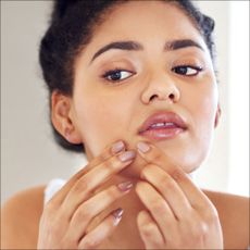 woman popping pimple from acne purge