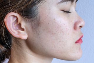 A close up shot of a woman side on, showing what are acne scars