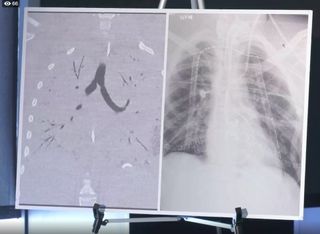Doctors showed an image of the vaping-damaged lungs of the 16-year-old who just received a double-lung transplant.