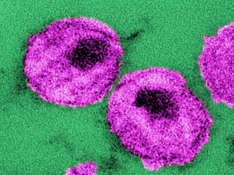 HIV, or Human Immunodeficiency Virus particles, in purple, cause the disease AIDS. 