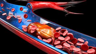 An artist&#039;s rendering of a cross-sectioned artery. Red blood cells flow through the artery, but get stuck at a large clot.