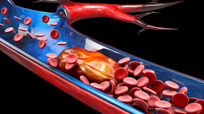 An artist's rendering of a cross-sectioned artery. Red blood cells flow through the artery, but get stuck at a large clot.