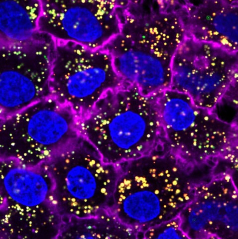 A microscope image of cancer cells with gold nanoparticles