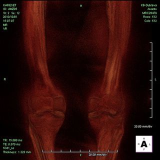 An MRI scan of an ancient Egyptian mummy's knees.