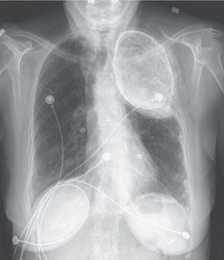 A chest X-ray showing oleothorax in the upper left part of a woman's lung.