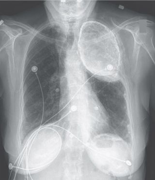 A chest X-ray showing oleothorax in the upper left part of a woman&#039;s lung.