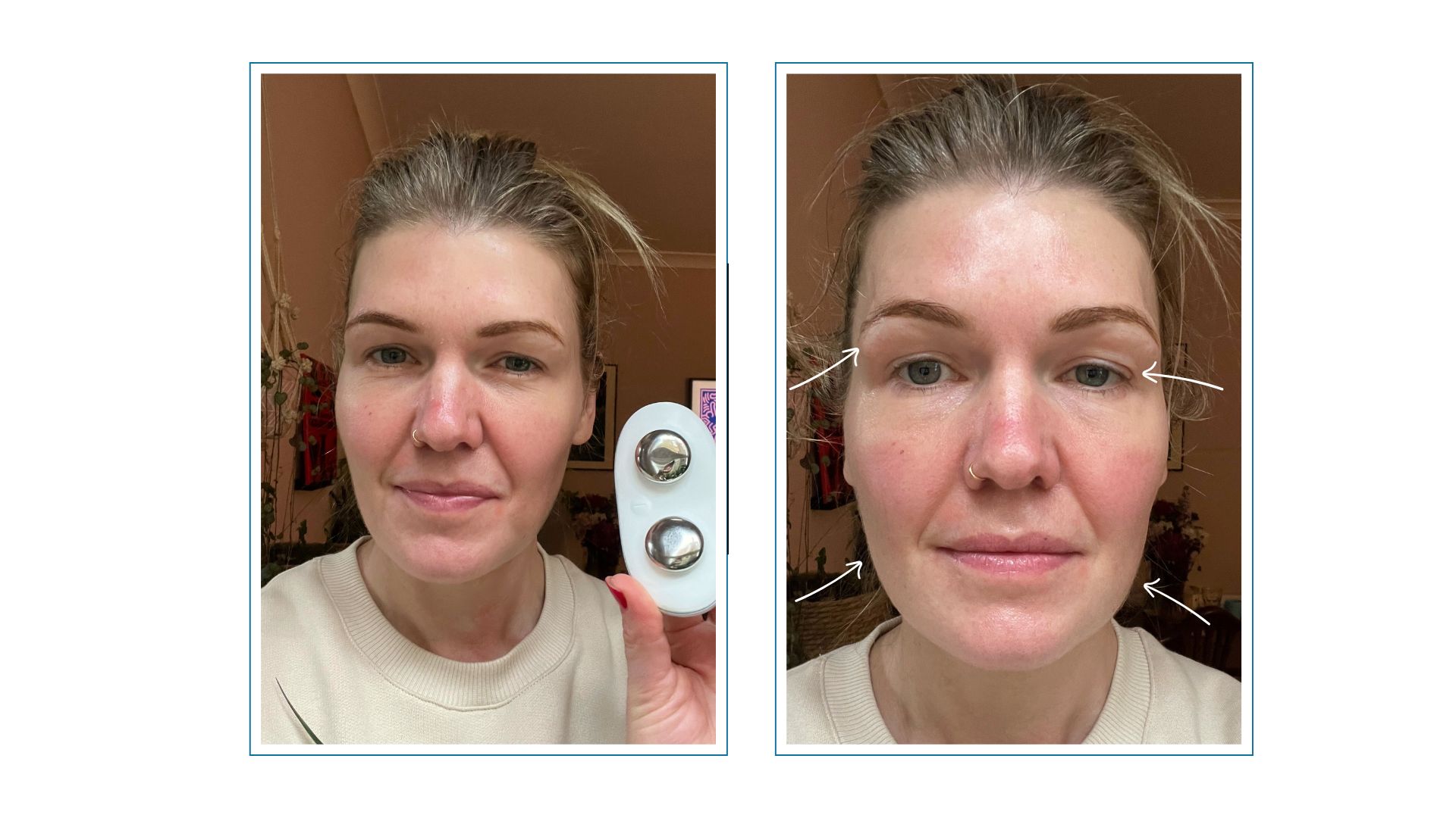 Fiona mckim holding a ziip halo device next to an image of her face, with one half treated by the tool and arrow pointing to her eyes and cheeks