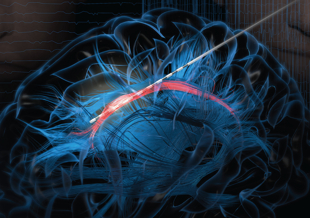 An illustration shows an electrode stimulating a bundle of white matter called the cingulum bundle.