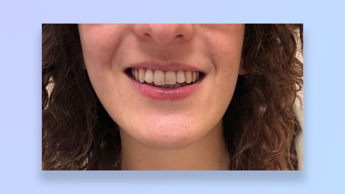 a photo of the author's teeth before/after using the suri core 1.0 toothbrush