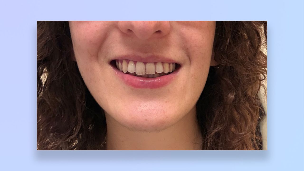 a photo of the author's teeth before/after using the suri core 1.0 toothbrush