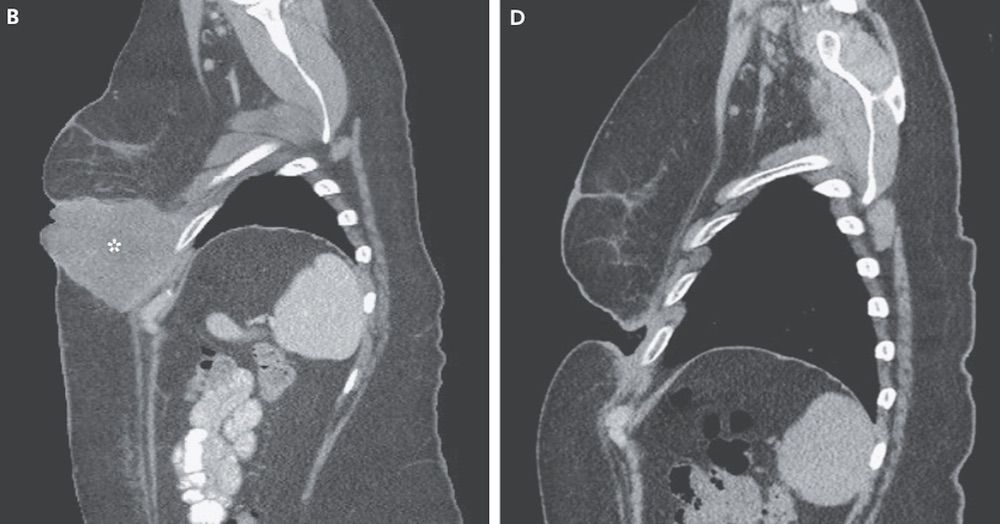 CT Scan of melanoma tumor