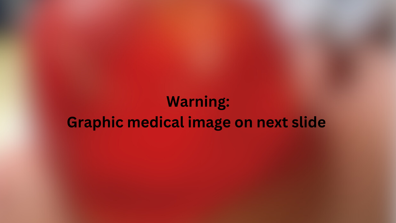 A blurred image with a medical disclaimer in black text which reads "Warning: Graphic medical image on next slide"