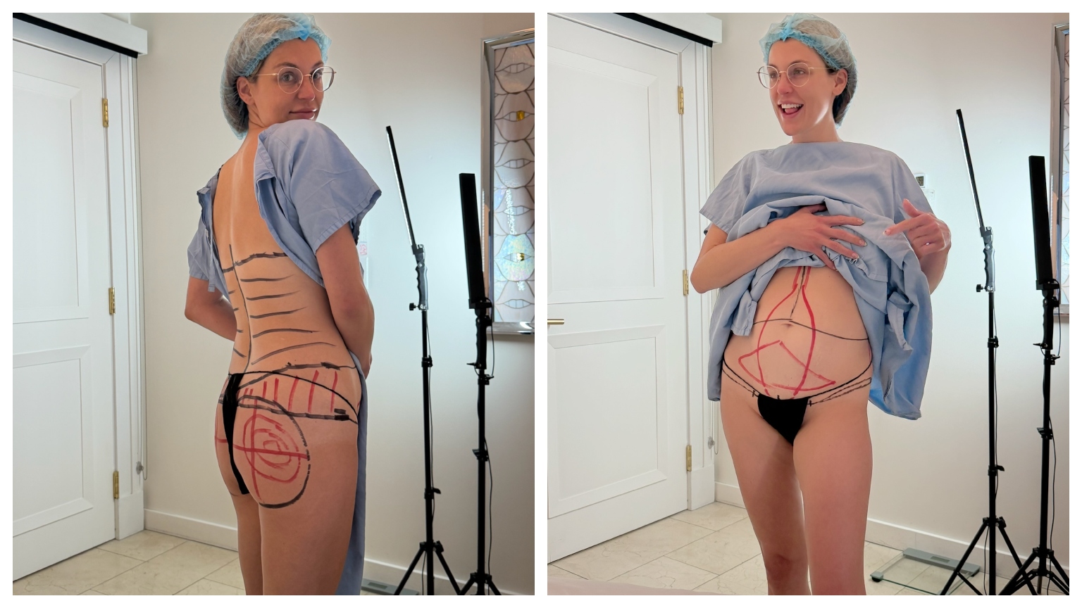 a woman in a blue hospital gown and hair net with surgery markings for a tummy tuck and BBL in black market on her stomach and butt