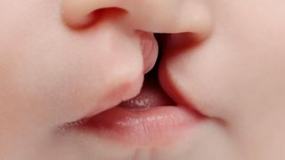 A close-up of a baby's cleft palate