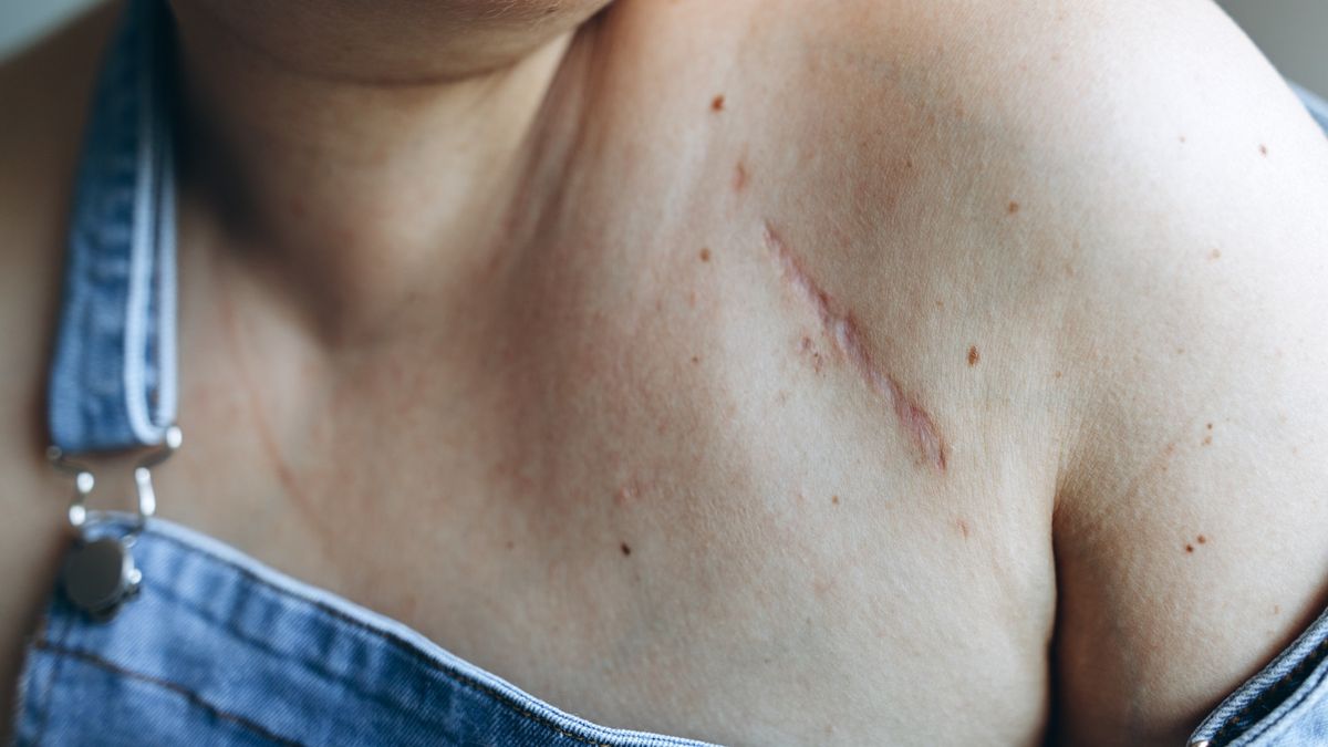 Close-up of a scar on the upper-right-hand-side of a person&#039;s chest. They appear to be wearing blue denim overalls and one of the shoulder straps is falling down their arm to showcase the scar. The scar is red and darker than the skin around it and is a long, thin line. 