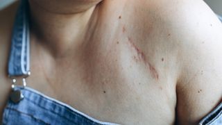 Close-up of a scar on the upper-right-hand-side of a person&#039;s chest. They appear to be wearing blue denim overalls and one of the shoulder straps is falling down their arm to showcase the scar. The scar is red and darker than the skin around it and is a long, thin line. 